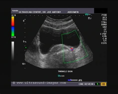 cochinblogs: Twinkle (color Doppler) artifacts in urinary calculi