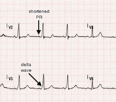 delta waves ecg