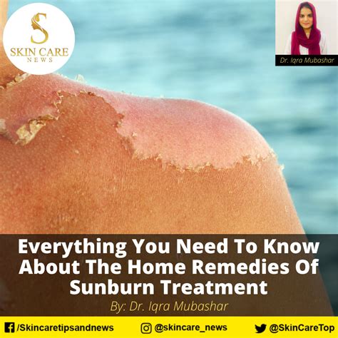 Everything you need to know about home remedies of Sunburn