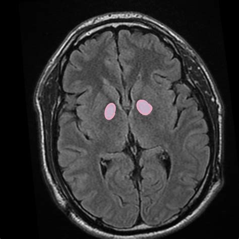 Neuroanatomy Glossary: Carbon Monoxide Poisoning | ditki medical & biological sciences