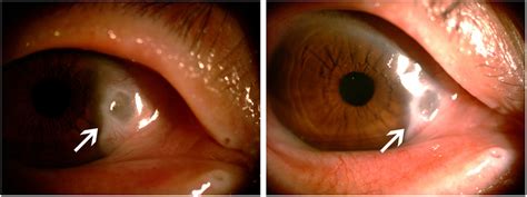 Three months after the treatment with tocilizumab. Visio oculus dexter:... | Download Scientific ...