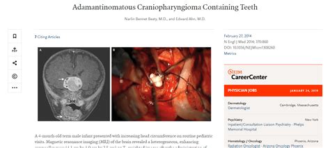 Teratoma Tumor: The demonic mass that grows teeth, eyes, feet, and organs | Gnostic Warrior By ...