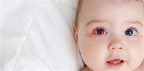 Conjunctivitis in Babies - Treatment and Symptoms Of Conjunctivitis ...