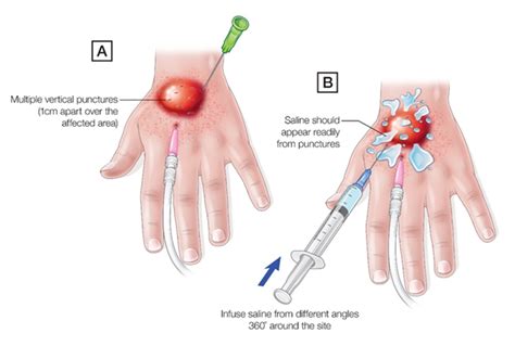 Infiltration and Extravasation - Medical Surgical