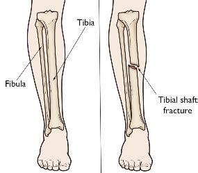 Broken Tibia | Tibial Shaft Fracture Diagnosis & Treatments | ROC