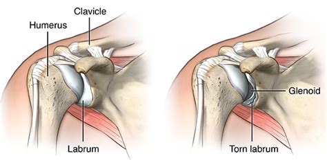 Shoulder Dislocation and Instability (labrum tear) — Huang Orthopaedics