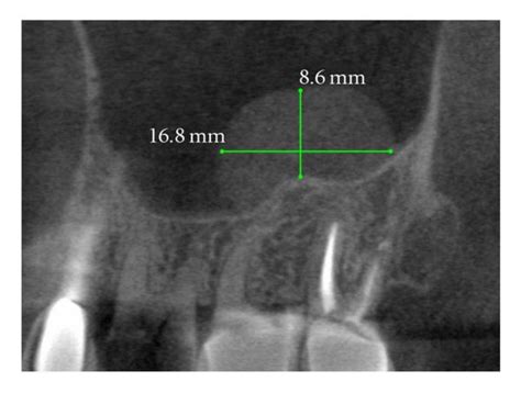 Retention Cyst Of The Maxillary Sinus Image