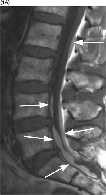 Subdural Hematoma Mri