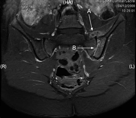 Sacroiliac Joint Dysfunction Mri