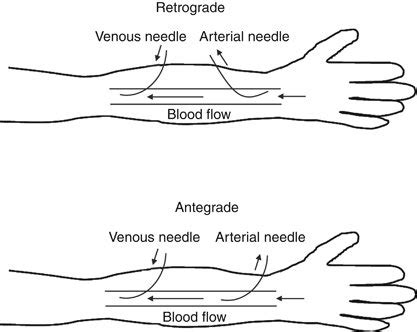 Retrograde and antegrade positioning of arterial and venous access... | Download Scientific Diagram