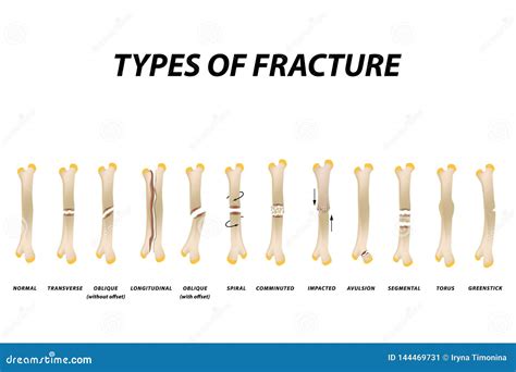 Types of Fracture. Fracture Bone Set. Infographics. Vector Illustration on Isolated Background ...