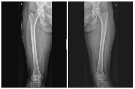 JCM | Free Full-Text | Bilateral Atypical Femoral Fractures after Bisphosphonate Treatment for ...