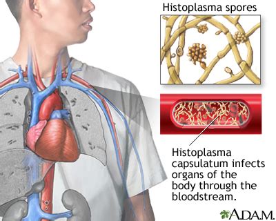 Histoplasmosis - disseminated | UF Health, University of Florida Health