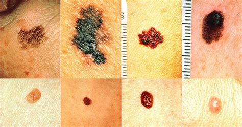 How To Recognize Skin Cancer – This Could Save Your Life