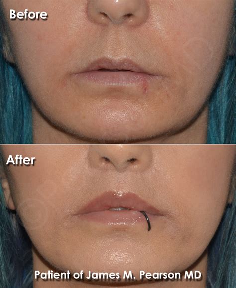 Corner Lip Lift - Dr. James Pearson Facial Plastic Surgery