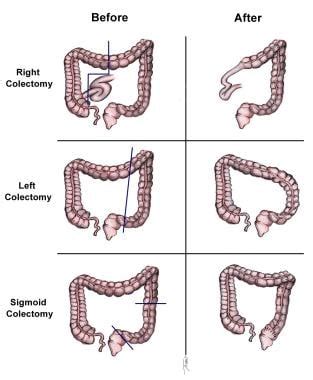 Sigmoid Colon Cancer Signs And Symptoms - CancerWalls