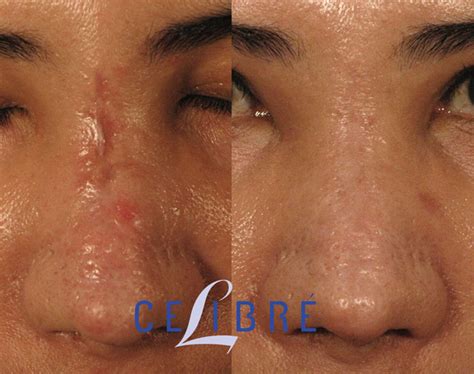 Laser Scar Removal in Torrance and Los Angeles