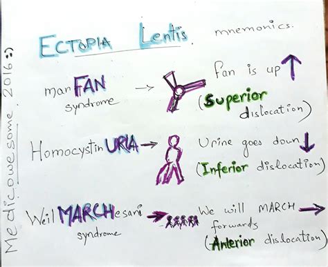 Medicowesome: Ectopia lentis mnemonic