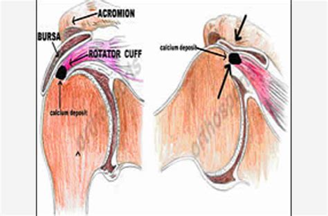 Calcific Bursitis