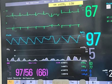 A Systematic Approach to Capnography Waveforms - JEMS: EMS, Emergency ...