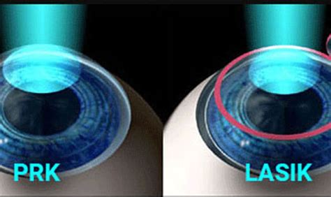 Learn about PRK eye surgery. What is the PRK recovery timeline. Comparing PRK vs LASIK. Which ...