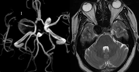 Dr Balaji Anvekar FRCR: ICA Aneurysm