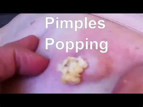 Pimples Popping 2023 #acne #popping #newvideo #compilation - YouTube