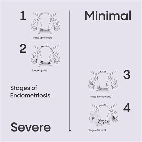 Endometriosis — Dr. Praveen De Silva - Gynaecologist