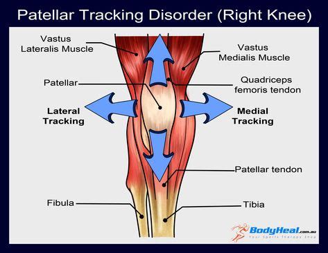 Patellar Tracking Disorder