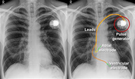 Pacemaker Chest X Ray