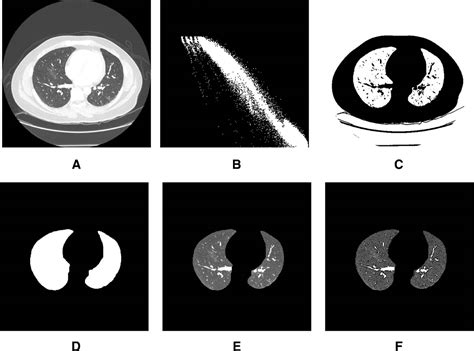 Modified and Optimized Method for Segmenting Pulmonary Parenchyma in CT ...