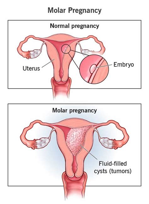 Hydatidiform mole meaning, causes, signs, symptoms, diagnosis & treatment