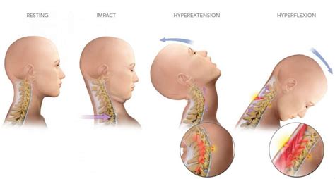 whiplash injury - Complete Spine and Pain Care