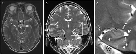 (a) Axial T2-weighted MRI depicting the right uncal apex (long white... | Download Scientific ...