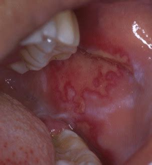 Discoid Lupus Erythematosus Oral Lesions