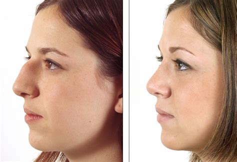 Nose plastic surgery - rhinoplasty