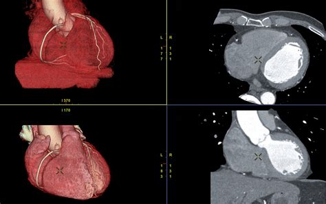 CT Coronary Angiogram — Dr Young Yu · Cardiologist · Sydney