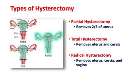 Hysterectomy Meaning