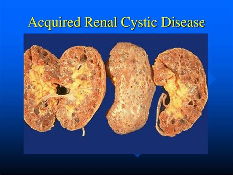 PPT - Renal Cystic Disease PowerPoint Presentation, free download - ID:1274490