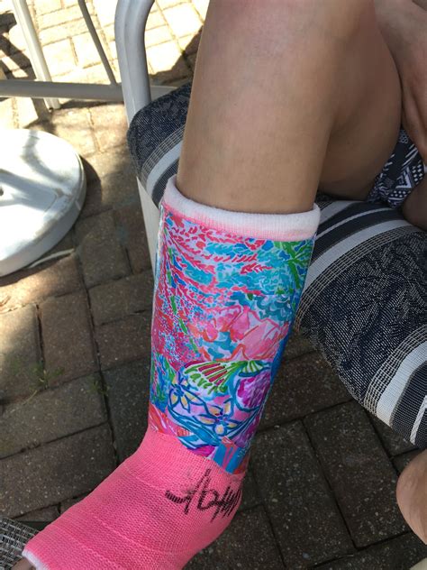 Summer leg cast using Lily Pulitzer paper print outs and Mod Podge. Covering the cast in the ...