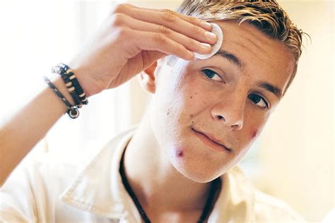 5 Best Acne Treatment for Teen Boys Reviews - Cosmetic News