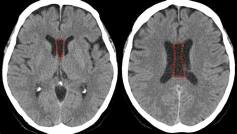 File:Cavum septum pellucidum, cavum vergae, and cavum veli interpositi ...