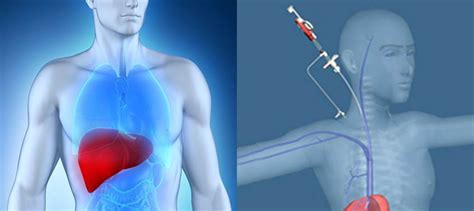 Transjugular Liver Biopsy | Varicose veins | Vascular surgeon | Stroke | DVT | Leg gangrene | Cancer