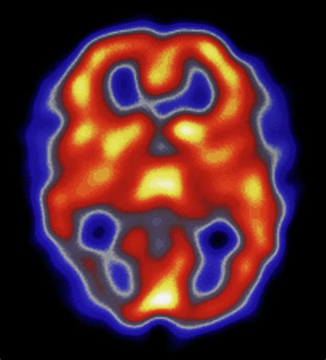 Colour Spect Scan Of Brain During Migraine Attack Photograph by Dept. Of Nuclear Medicine ...