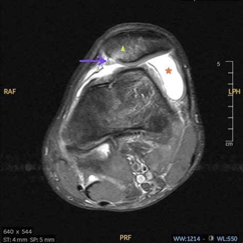 Patterns of Associated Knee Ligament and Chondral Injuries in First-Time Traumatic Patellar ...