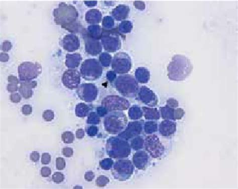 Large granular lymphocytic (LGL) lymphoma demonstrating azurophilic... | Download Scientific Diagram