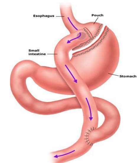 Vertical Gastric Sleeve Surgery for Long Term Weight Loss Diet