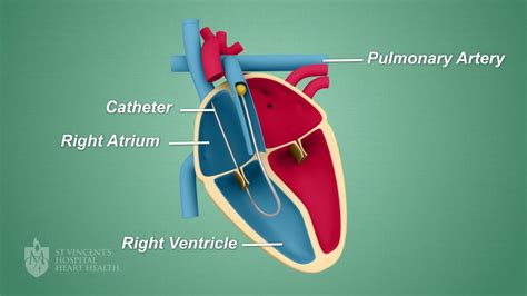 Right Heart Catheter