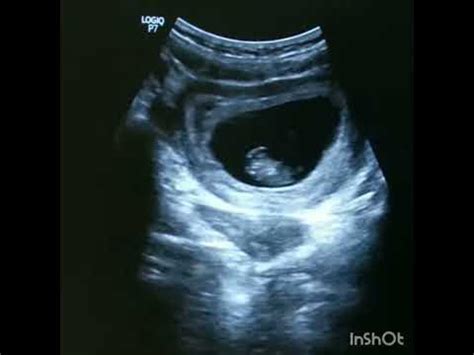 Ultrasound video showing early pregnancy in an arcuate uterus - YouTube