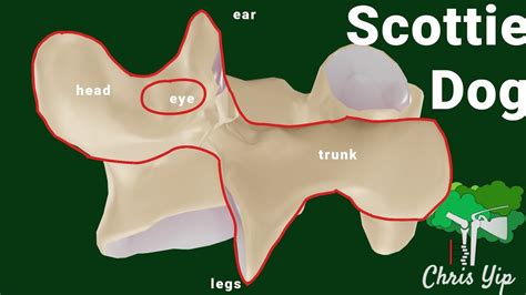 Spondylolisthesis Scotty Dog